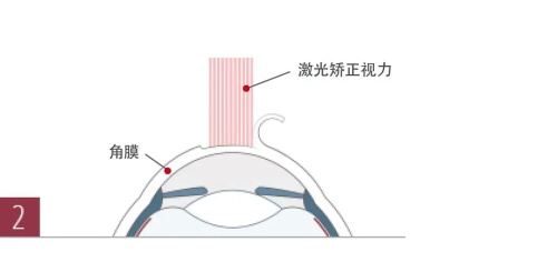 近视眼激光手术示意图