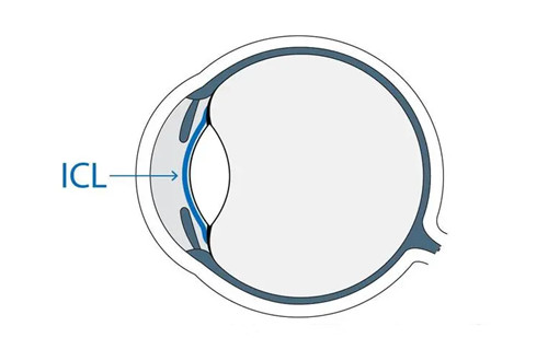 ICL植入位置示意图
