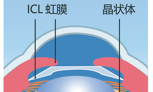 ICL晶体植入位置眼内示意图