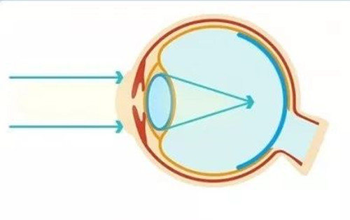 近视眼球成像卡通示意图