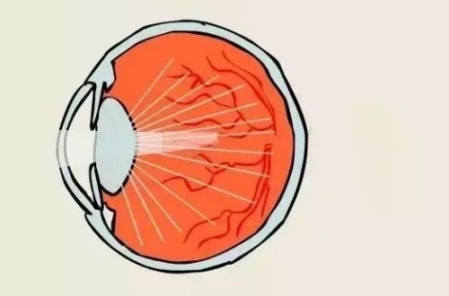 白内障的光线展示示意图