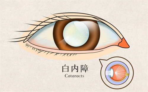 白内障情况动画图