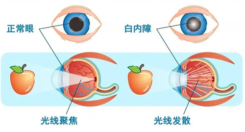 正常眼和白内障对比图