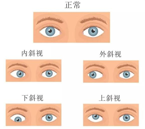 正常的眼睛和斜视的眼睛