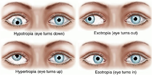 各类斜视的眼睛参考
