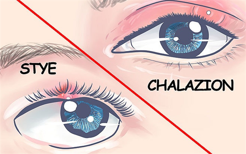 眼睛上起麦粒肿是什么引起的?有什么好的治疗方法吗?