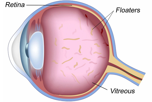 飞蚊症患者的晶体呈现