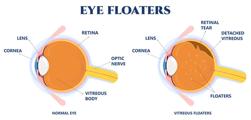 正常视野眼睛结构和飞蚊症视野眼睛结构