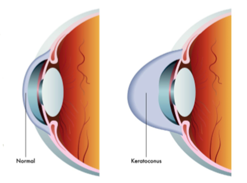 正常眼睛和圆锥角膜