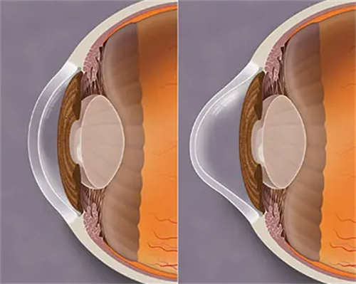 正常角膜和圆锥角膜对比