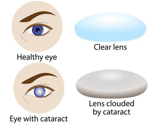 白内障和普通眼睛晶体的区别图解