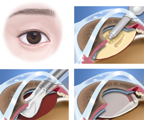白内障手术全过程图解