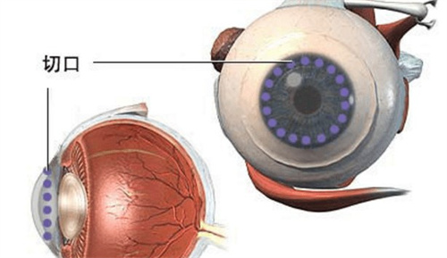 角膜移植的切口
