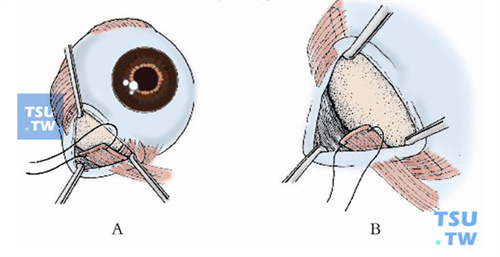 斜视手术示意图