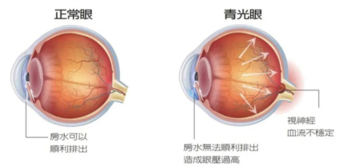 正常眼睛和青光眼的区别