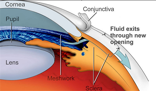 青光眼进行手术的部位