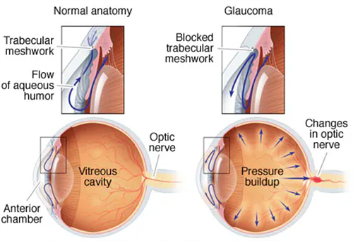 青光眼和正常眼睛的不同