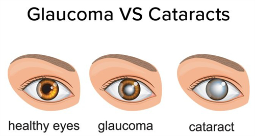 青光眼和白内障的不同