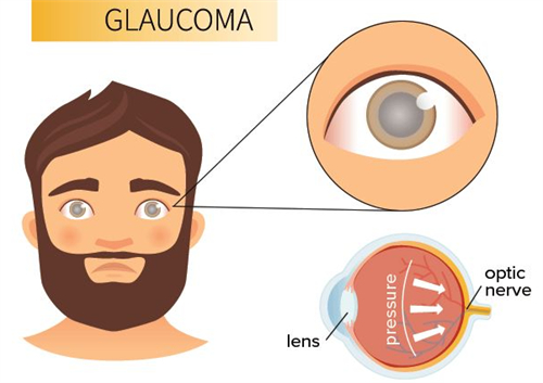 青光眼患者眼睛外观和眼睛结构