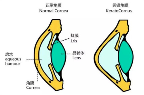 圆锥角膜解剖图