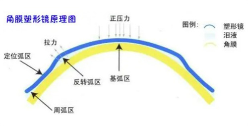 rgp与ok镜的区别到底有啥？终于有人讲清楚了！