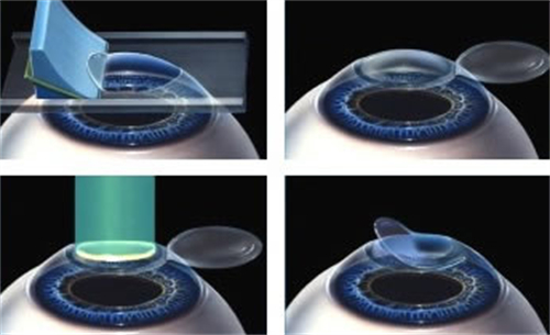 准分子激光手术过程
