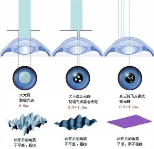 准分子激光手术前后眼睛对比