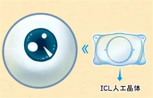 近视手术是选icl晶体植入还是全飞秒激光?哪种方法更好?