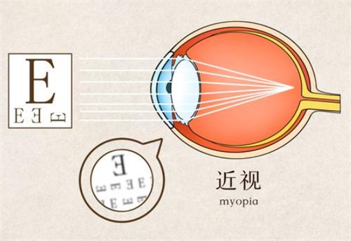 近视视物的样子图解