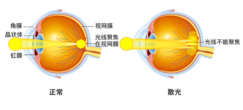 散光视物和正常视物的区别