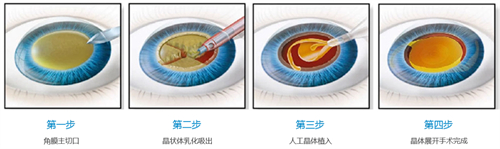 超声乳化白内障吸除术手术步骤