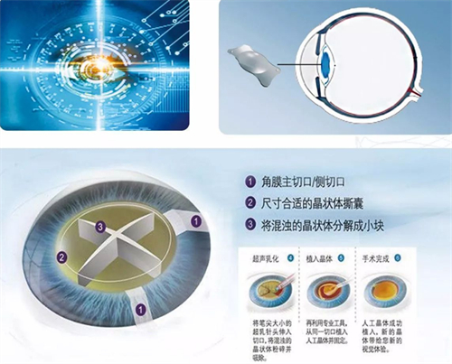 飞秒白内障手术过程