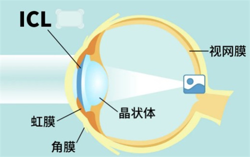 icl晶体植入怎么做