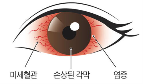 干眼症的样子图解