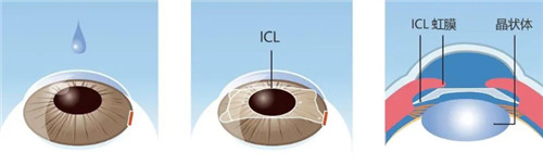 晶体植入手术细节图