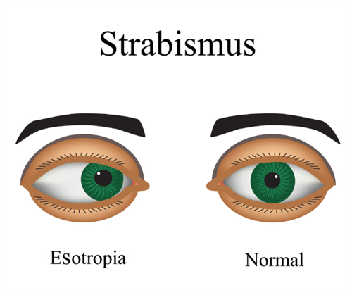 斜视和正常眼睛的区别图解