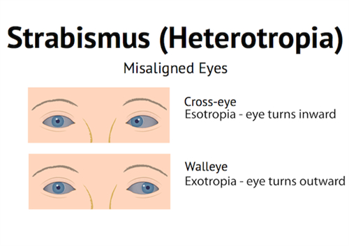眼睛斜视的样子图解