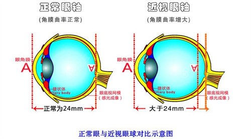 正常眼和近视眼对比图