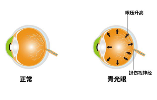 正常眼睛和青光眼的区别图解