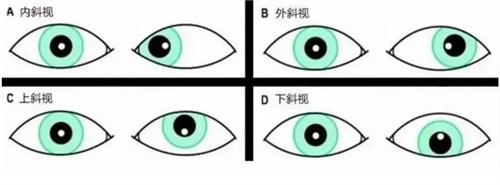 斜视的类型