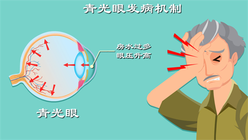 青光眼发病机制图解