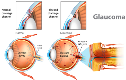 青光眼和正常眼睛的区别