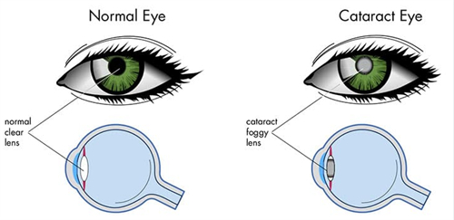 白内障眼睛和正常眼睛晶体不同