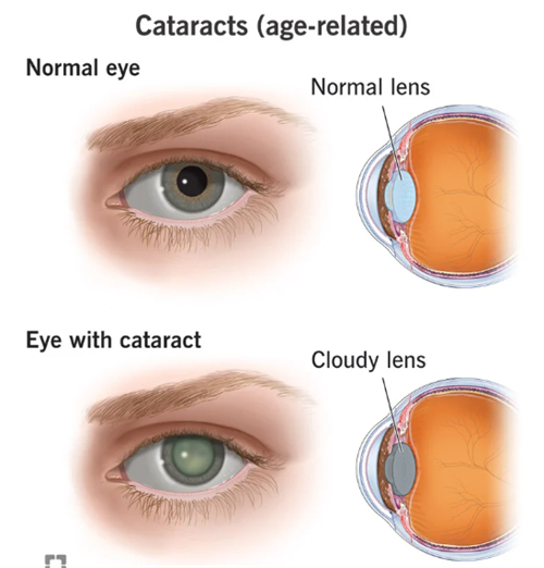 正常眼睛和白内障眼睛不一样