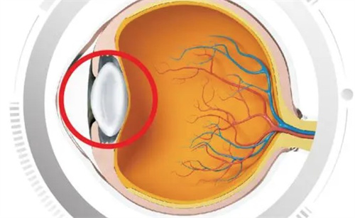 20岁年轻人会得白内障吗？二十多岁白内障是什么引起的