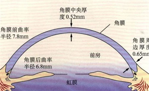 圆锥角膜的眼球