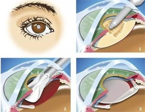 晶体植入手术过程图