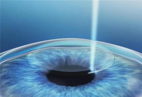 爱尔眼科做近视眼技术成熟吗？深度剖析爱尔眼科技术能力
