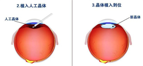 白内障人工晶体