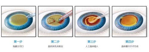 白内障手术的过程